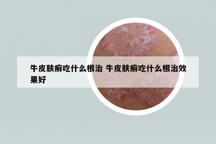 牛皮膚癬吃什么根治 牛皮膚癬吃什么根治效果好