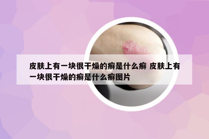 皮膚上有一塊很干燥的癬是什么癬 皮膚上有一塊很干燥的癬是什么癬圖片
