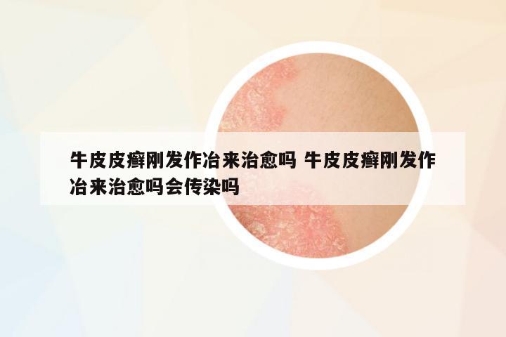 牛皮皮癬剛發(fā)作冶來治愈嗎 牛皮皮癬剛發(fā)作冶來治愈嗎會(huì)傳染嗎