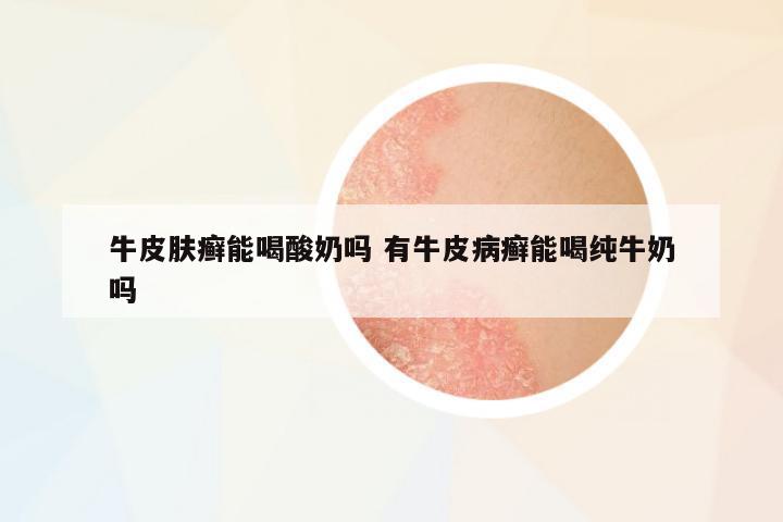 牛皮膚癬能喝酸奶嗎 有牛皮病癬能喝純牛奶嗎