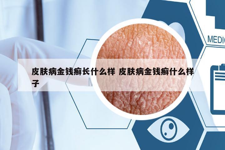 皮膚病金錢癬長什么樣 皮膚病金錢癬什么樣子