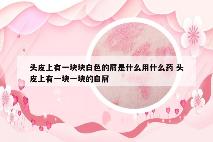 頭皮上有一塊塊白色的屑是什么用什么藥 頭皮上有一塊一塊的白屑