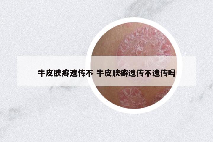 牛皮膚癬遺傳不 牛皮膚癬遺傳不遺傳嗎