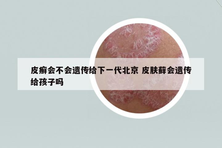 皮癬會不會遺傳給下一代北京 皮膚蘚會遺傳給孩子嗎