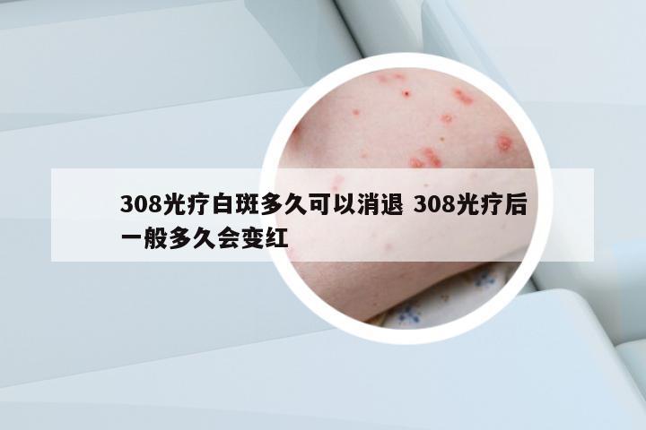 308光療白斑多久可以消退 308光療后一般多久會變紅