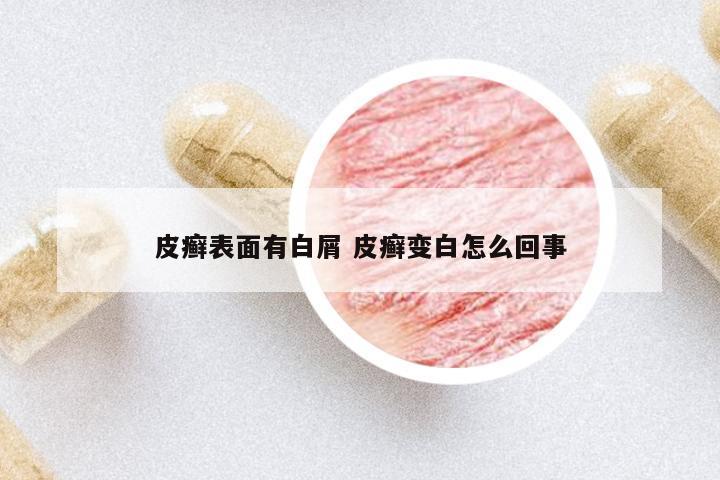 皮癬表面有白屑 皮癬變白怎么回事