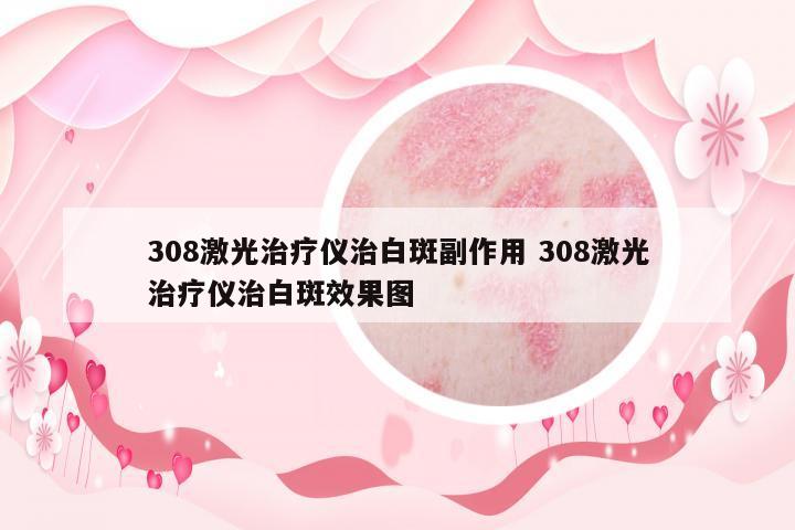 308激光治療儀治白斑副作用 308激光治療儀治白斑效果圖