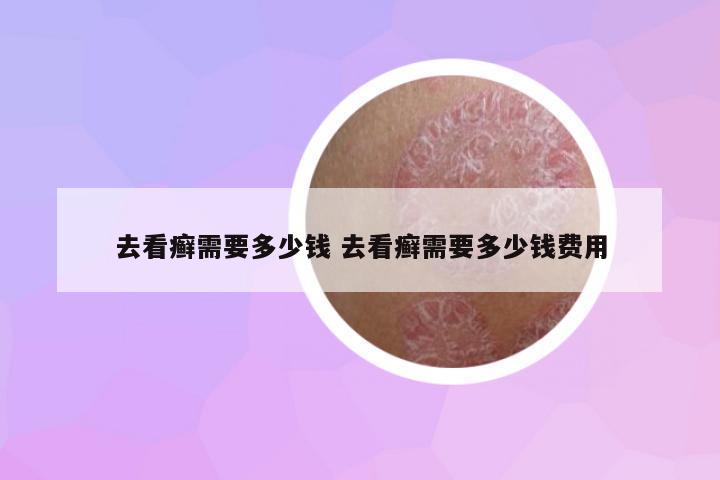 去看癬需要多少錢(qián) 去看癬需要多少錢(qián)費(fèi)用
