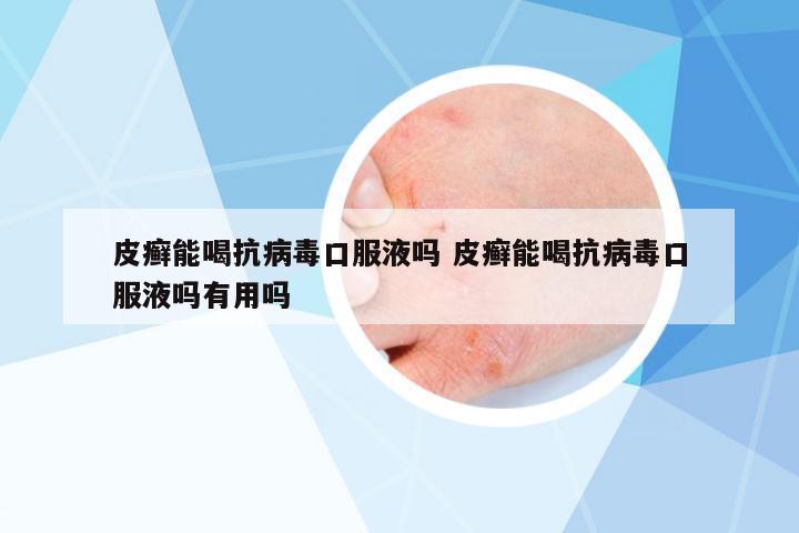 皮癬能喝抗病毒口服液嗎 皮癬能喝抗病毒口服液嗎有用嗎