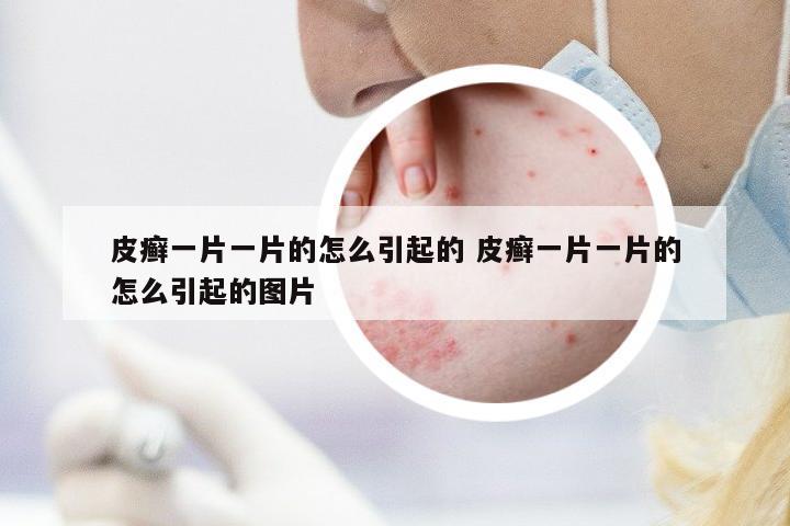 皮癬一片一片的怎么引起的 皮癬一片一片的怎么引起的圖片