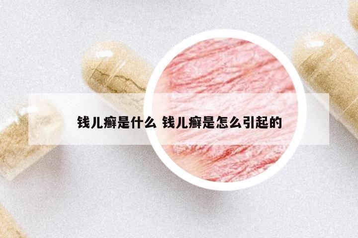 錢兒癬是什么 錢兒癬是怎么引起的
