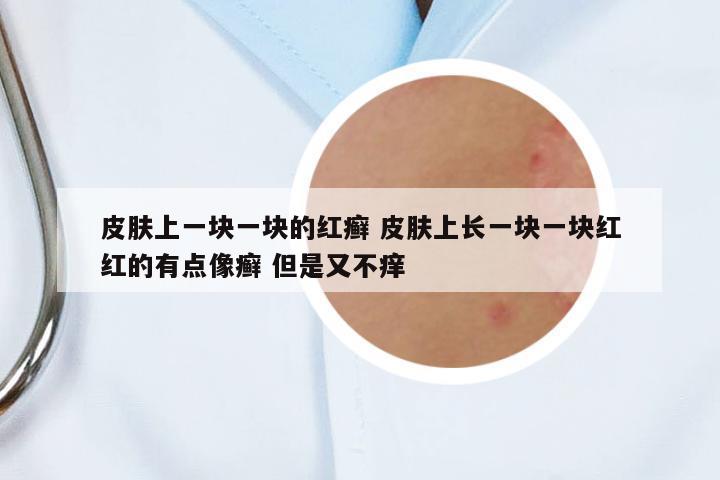 皮膚上一塊一塊的紅癬 皮膚上長一塊一塊紅紅的有點像癬 但是又不癢