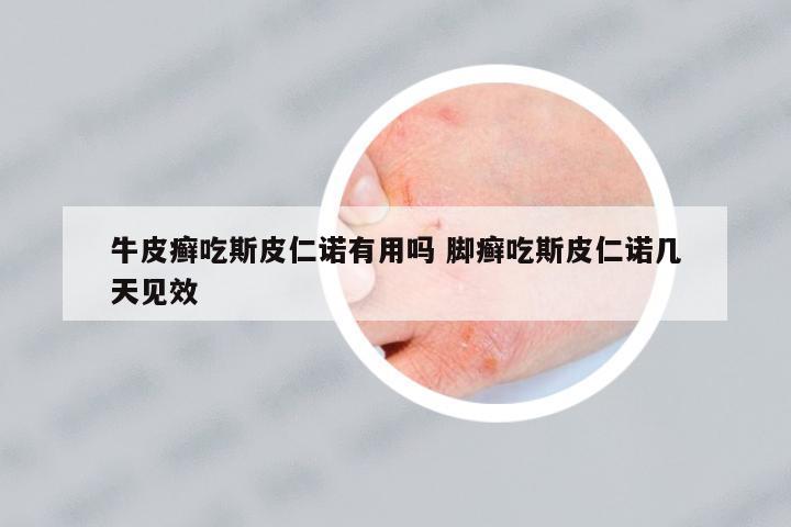 牛皮癬吃斯皮仁諾有用嗎 腳癬吃斯皮仁諾幾天見效