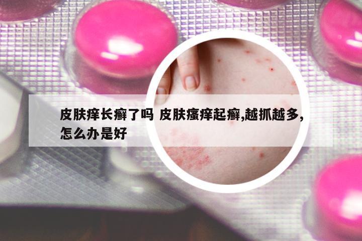 皮膚癢長(zhǎng)癬了嗎 皮膚瘙癢起癬,越抓越多,怎么辦是好