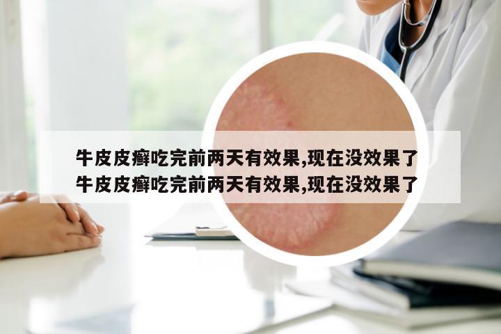 牛皮皮癬吃完前兩天有效果,現(xiàn)在沒(méi)效果了 牛皮皮癬吃完前兩天有效果,現(xiàn)在沒(méi)效果了