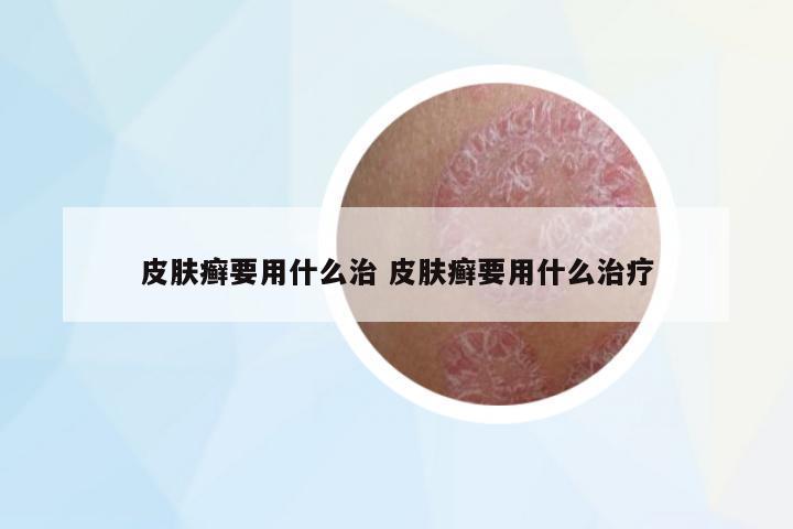 皮膚癬要用什么治 皮膚癬要用什么治療