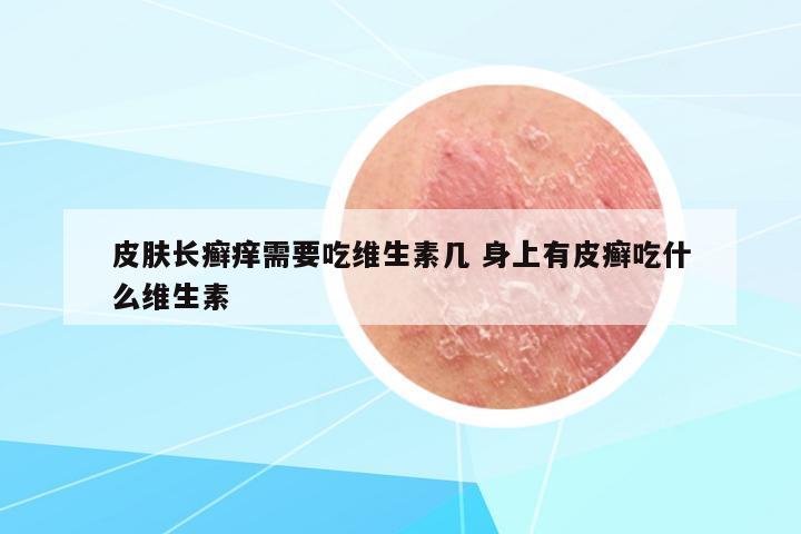 皮膚長癬癢需要吃維生素幾 身上有皮癬吃什么維生素
