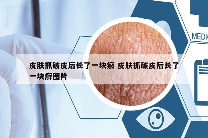 皮膚抓破皮后長(zhǎng)了一塊癬 皮膚抓破皮后長(zhǎng)了一塊癬圖片