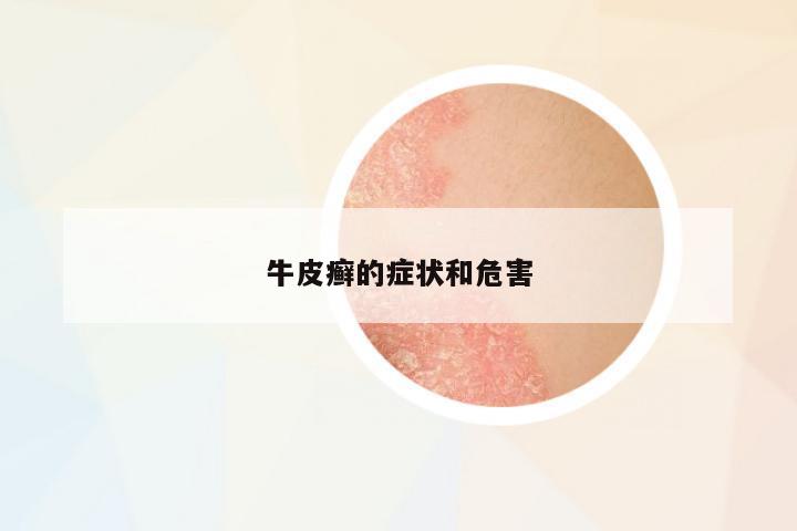 牛皮癬的癥狀和危害