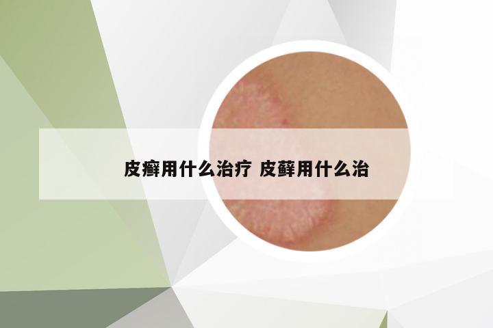 皮癬用什么治療 皮蘚用什么治