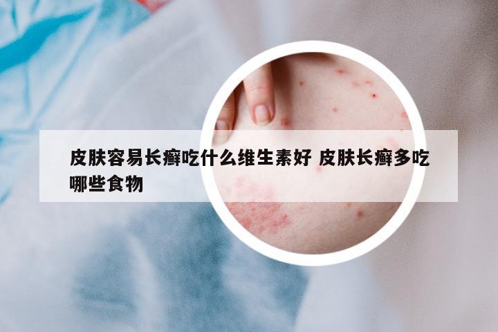 皮膚容易長(zhǎng)癬吃什么維生素好 皮膚長(zhǎng)癬多吃哪些食物