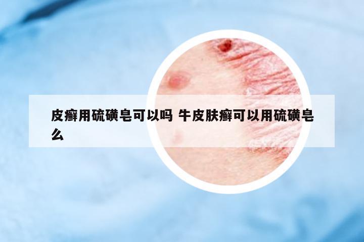 皮癬用硫磺皂可以嗎 牛皮膚癬可以用硫磺皂么