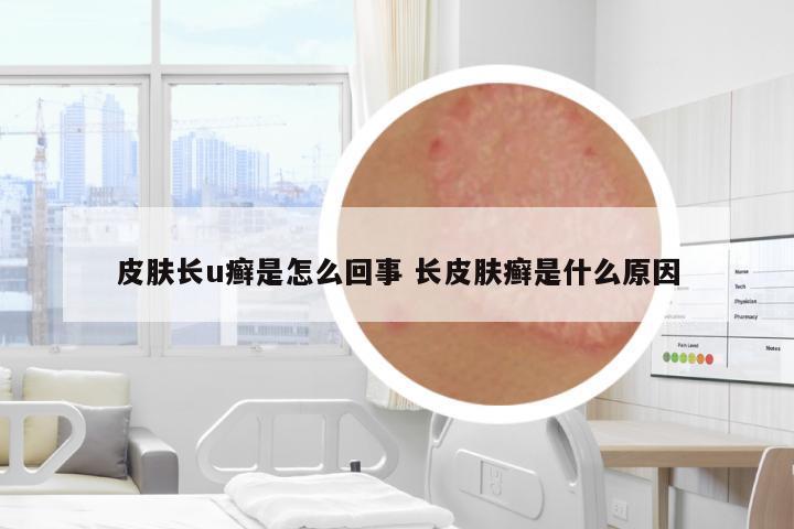皮膚長u癬是怎么回事 長皮膚癬是什么原因