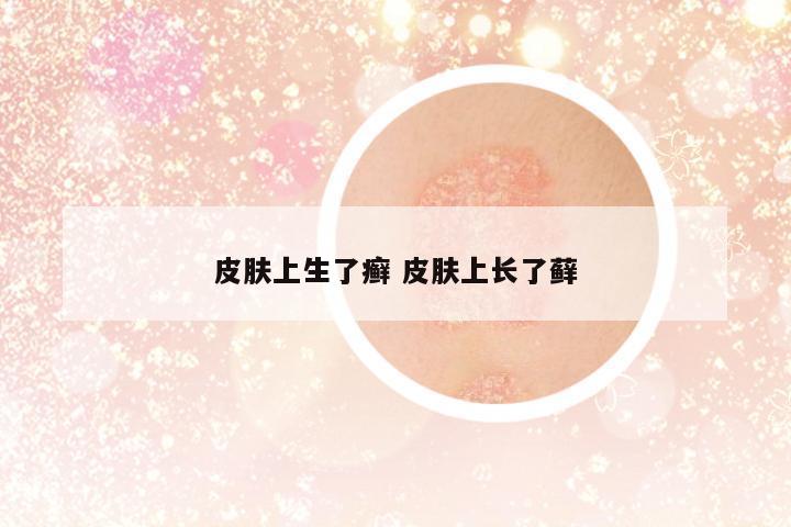 皮膚上生了癬 皮膚上長了蘚