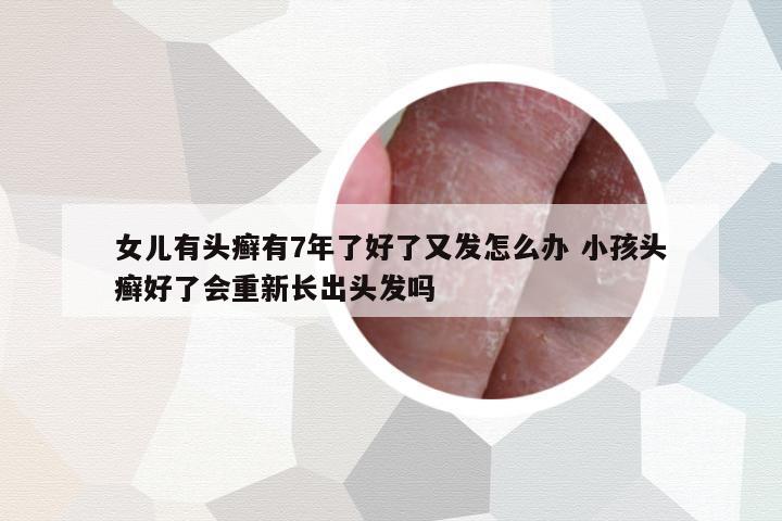 女兒有頭癬有7年了好了又發(fā)怎么辦 小孩頭癬好了會重新長出頭發(fā)嗎