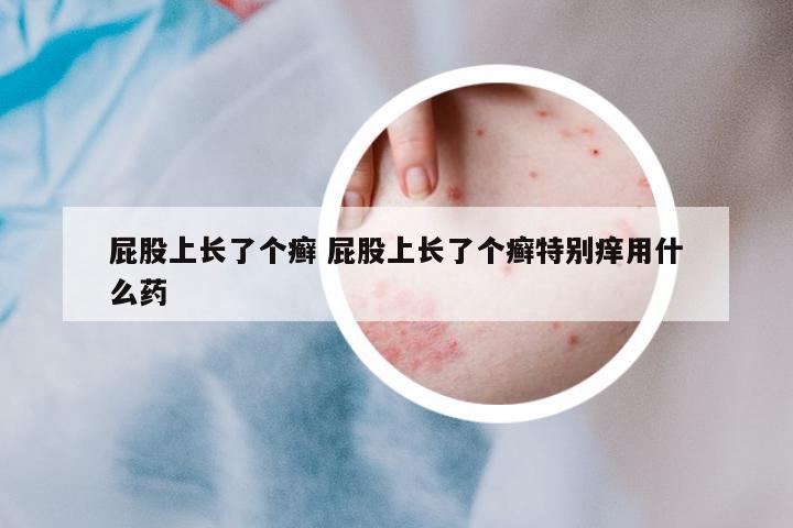 屁股上長了個癬 屁股上長了個癬特別癢用什么藥