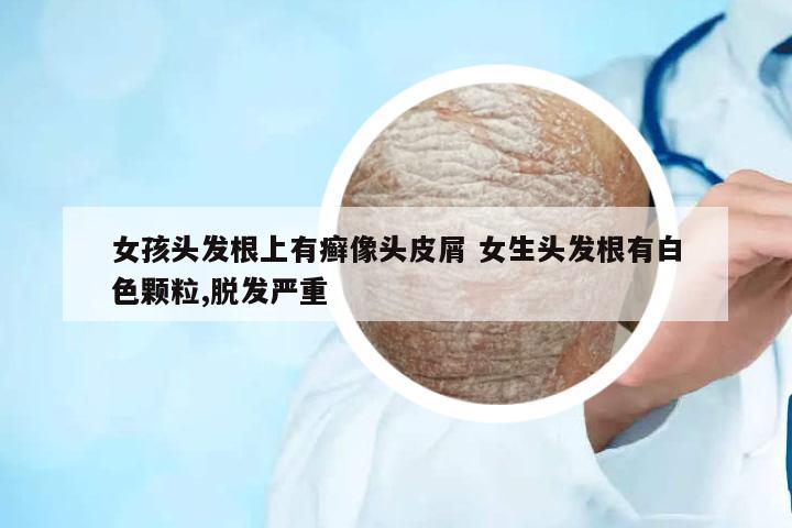 女孩頭發(fā)根上有癬像頭皮屑 女生頭發(fā)根有白色顆粒,脫發(fā)嚴(yán)重