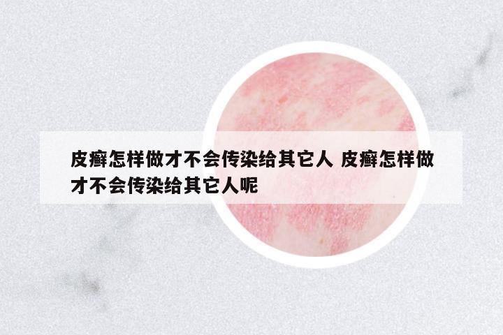 皮癬怎樣做才不會(huì)傳染給其它人 皮癬怎樣做才不會(huì)傳染給其它人呢