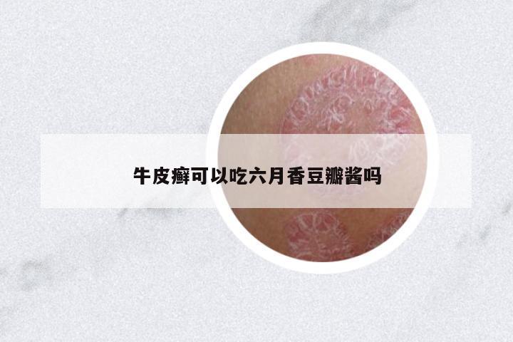 牛皮癬可以吃六月香豆瓣醬嗎