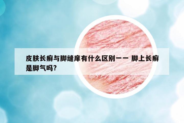 皮膚長癬與腳縫庠有什么區(qū)別一一 腳上長癬是腳氣嗎?