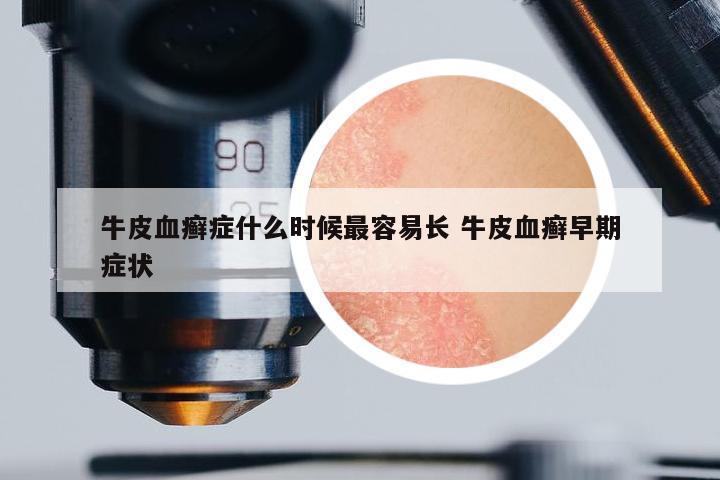 牛皮血癬癥什么時候最容易長 牛皮血癬早期癥狀