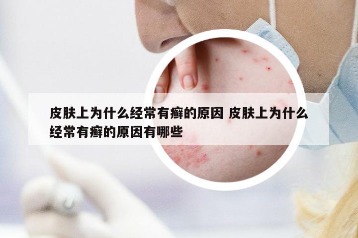 皮膚上為什么經(jīng)常有癬的原因 皮膚上為什么經(jīng)常有癬的原因有哪些