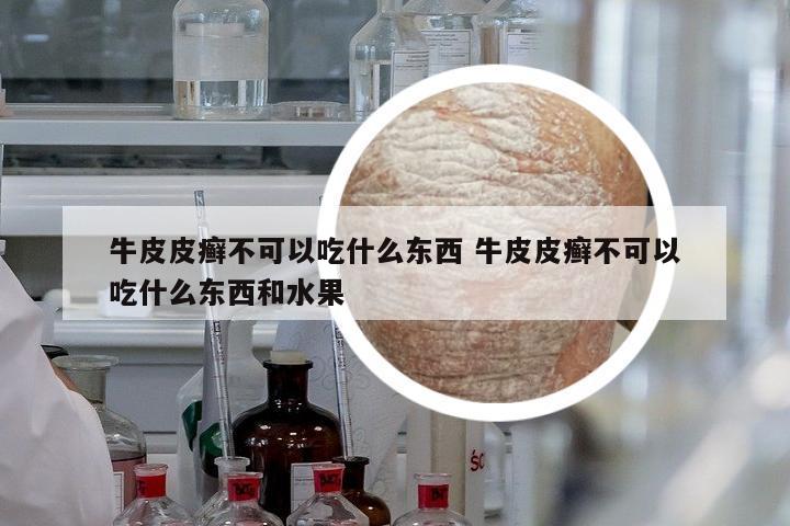 牛皮皮癬不可以吃什么東西 牛皮皮癬不可以吃什么東西和水果