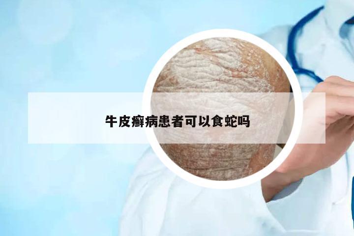 牛皮癬病患者可以食蛇嗎