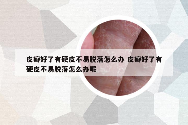 皮癬好了有硬皮不易脫落怎么辦 皮癬好了有硬皮不易脫落怎么辦呢