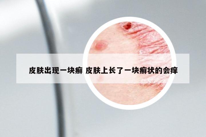 皮膚出現(xiàn)一塊癬 皮膚上長了一塊癬狀的會(huì)癢
