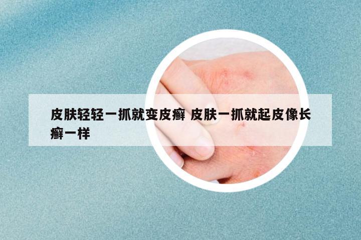 皮膚輕輕一抓就變皮癬 皮膚一抓就起皮像長(zhǎng)癬一樣
