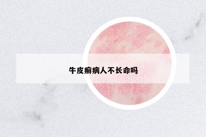 牛皮癬病人不長(zhǎng)命嗎