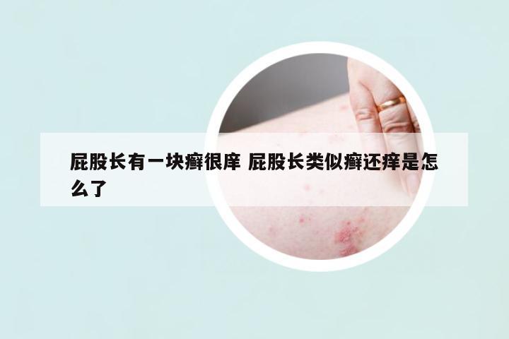 屁股長有一塊癬很庠 屁股長類似癬還癢是怎么了