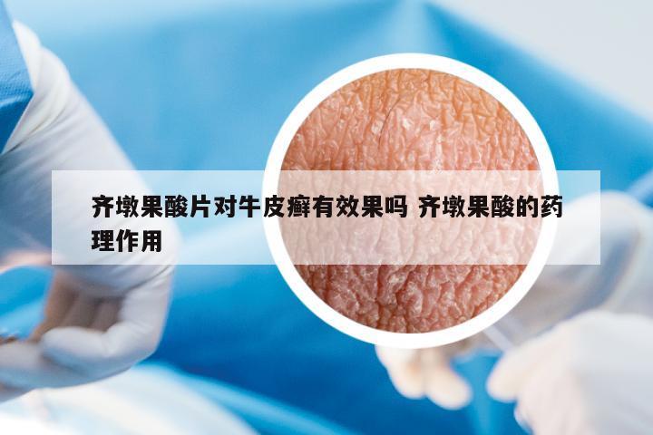 齊墩果酸片對牛皮癬有效果嗎 齊墩果酸的藥理作用