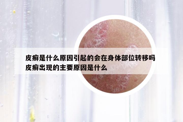 皮癬是什么原因引起的會在身體部位轉(zhuǎn)移嗎 皮癬出現(xiàn)的主要原因是什么