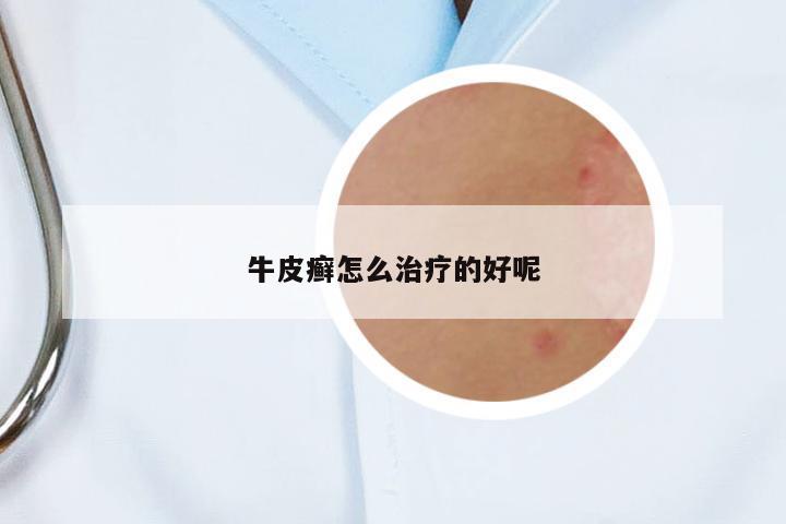牛皮癬怎么治療的好呢