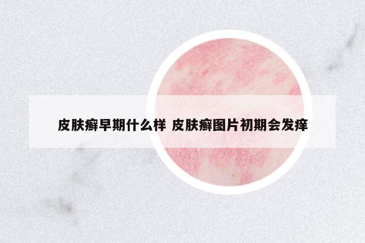 皮膚癬早期什么樣 皮膚癬圖片初期會(huì)發(fā)癢