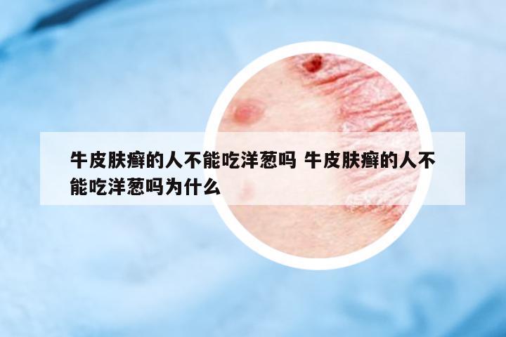 牛皮膚癬的人不能吃洋蔥嗎 牛皮膚癬的人不能吃洋蔥嗎為什么