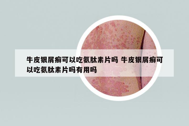 牛皮銀屑癬可以吃氨肽素片嗎 牛皮銀屑癬可以吃氨肽素片嗎有用嗎