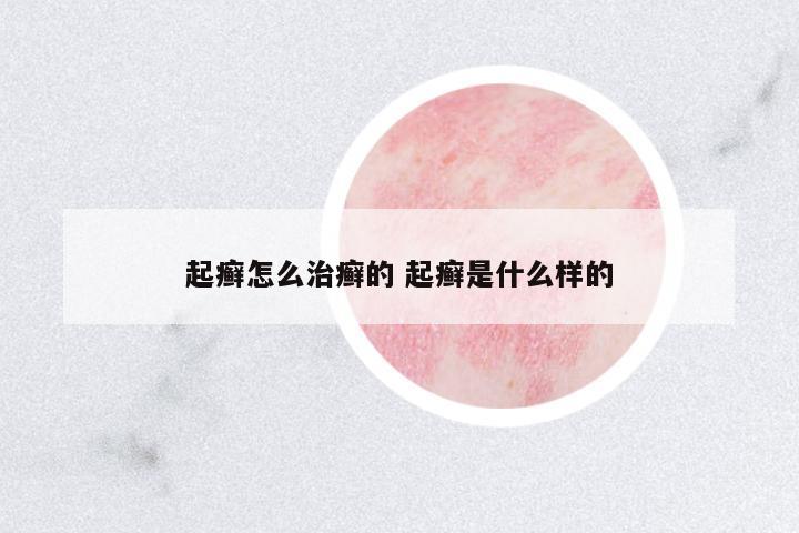 起癬怎么治癬的 起癬是什么樣的